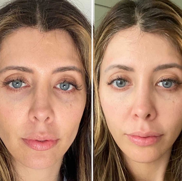 Red Light Therapy Before and After: Does It Really Work? 30 Red Light Therapy Before and After: Does It Really Work?