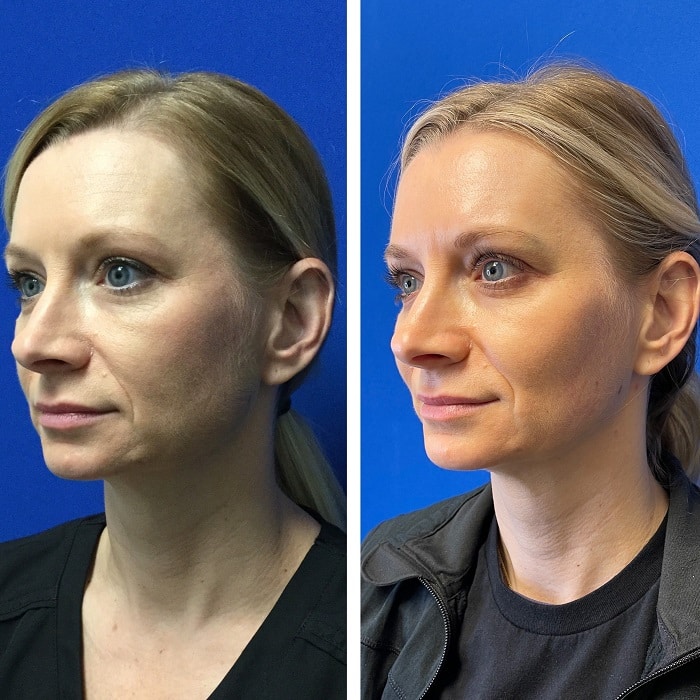 Sculptra Before and After: Transforming Your Appearance with Long-Lasting Results