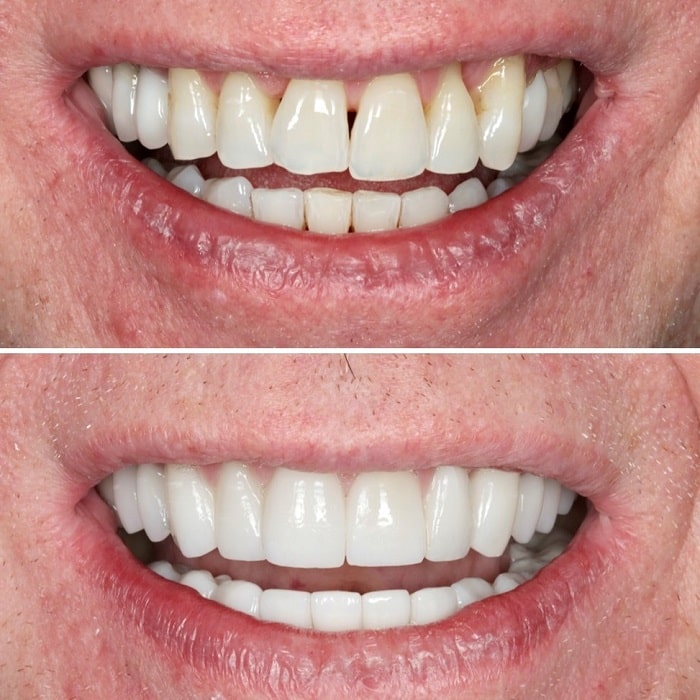 Invisalign Before and After: Transforming Your Smile with Clear Aligners
