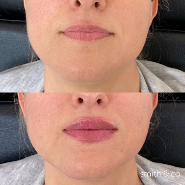 Lip Lift Before and After Dramatic Results and Recovery Process Must Read This Before Buying