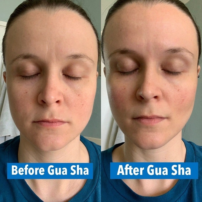 Gua Sha Before and After: Benefits and Results 4 Gua Sha Before and After: Benefits and Results