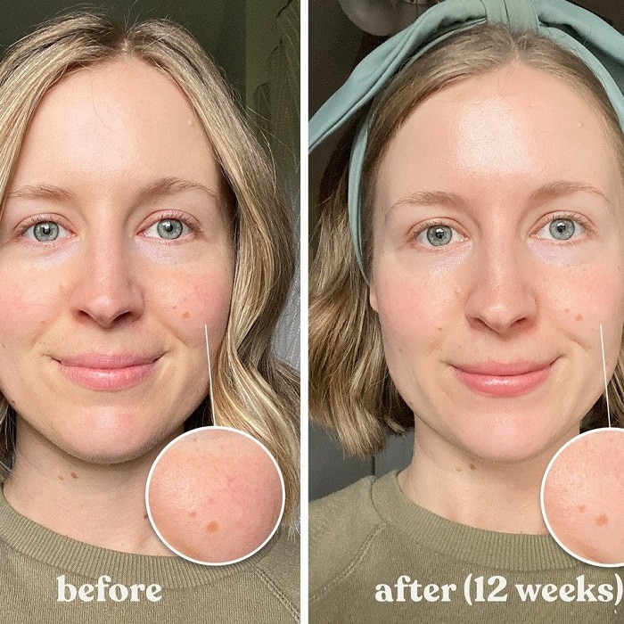 Red Light Therapy Before and After: Does It Really Work? 4 Red Light Therapy Before and After: Does It Really Work?