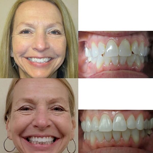 Invisalign Before and After: Transforming Your Smile with Clear ...