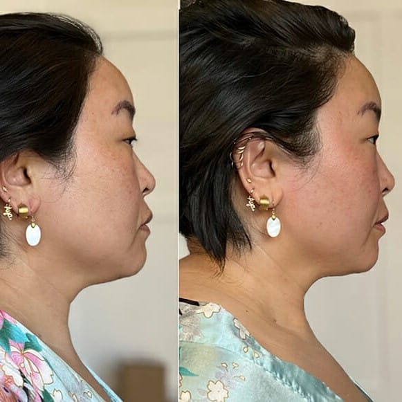 Gua Sha Before and After: Benefits and Results 31 Gua Sha Before and After: Benefits and Results