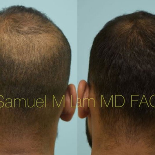 Minoxidil Before and After: Real Results and Photos