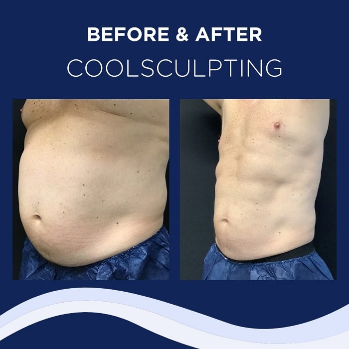 Coolsculpting Before and After: Results, Side Effects, and What to Expect 31 Coolsculpting Before and After: Results, Side Effects, and What to Expect