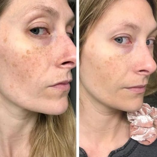 Retinol Before and After: Transform Your Skin with These Results