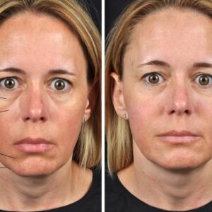 Sculptra Before and After: Transforming Your Appearance with Long