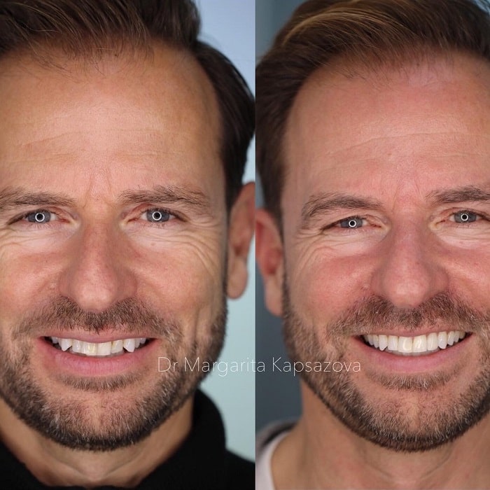 Invisalign Before and After: Transforming Your Smile with Clear Aligners