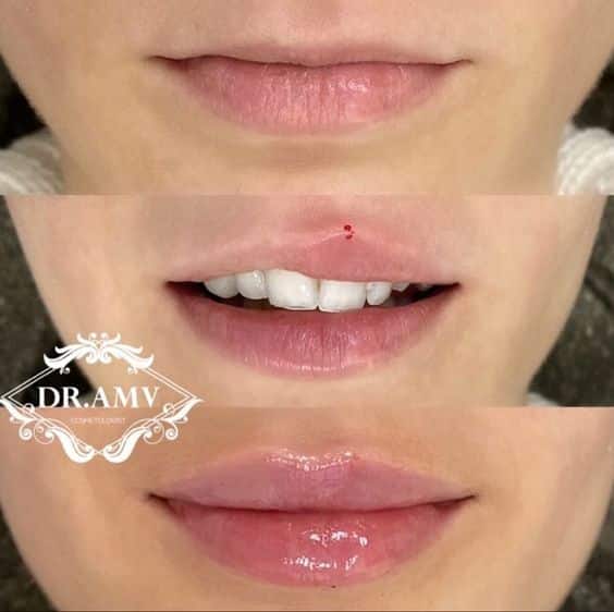 Lip Lift Before and After: Dramatic Results and Recovery Process