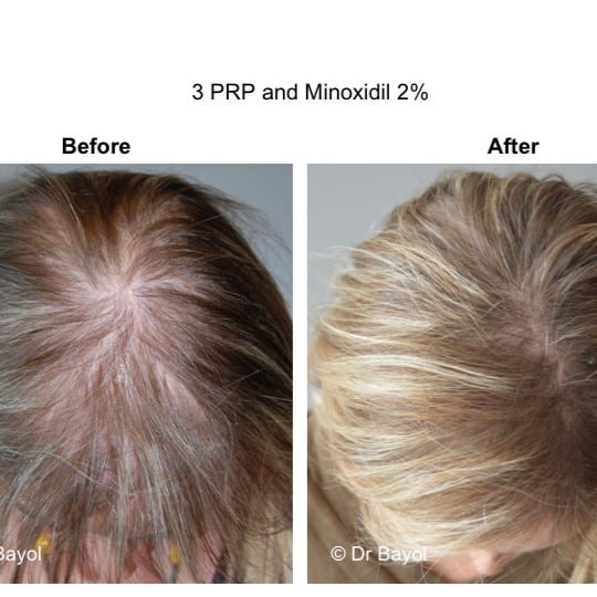 Minoxidil Before and After: Real Results and Photos