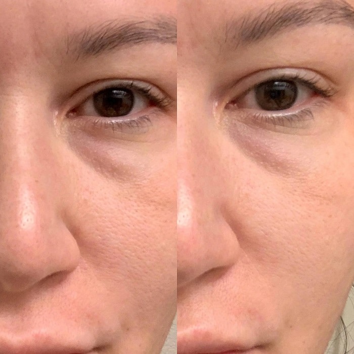 The Ordinary Peeling Solution Before and After: A Comprehensive Review