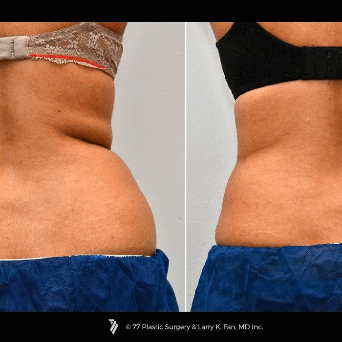 Coolsculpting Before and After: Results, Side Effects, and What to Expect 5 Coolsculpting Before and After: Results, Side Effects, and What to Expect