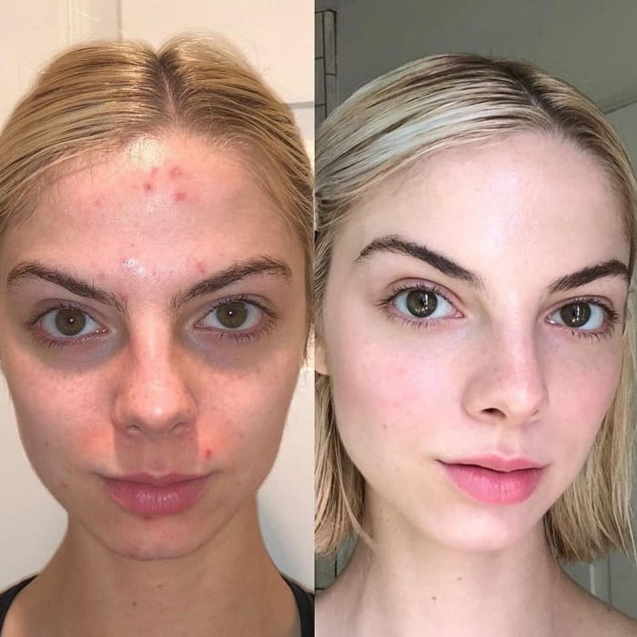 Retinol Before and After: Transform Your Skin with These Results