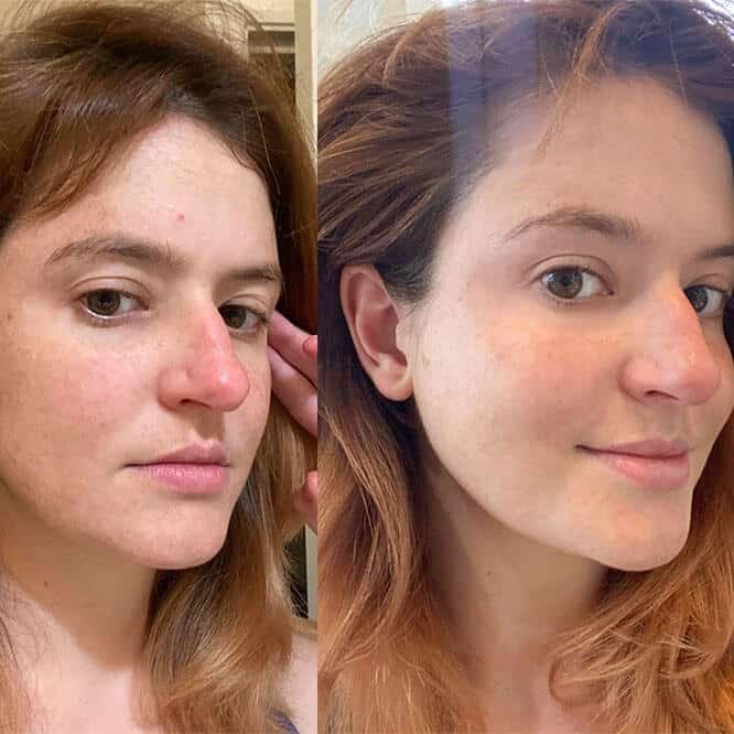 Red Light Therapy Before and After: Does It Really Work? 5 Red Light Therapy Before and After: Does It Really Work?