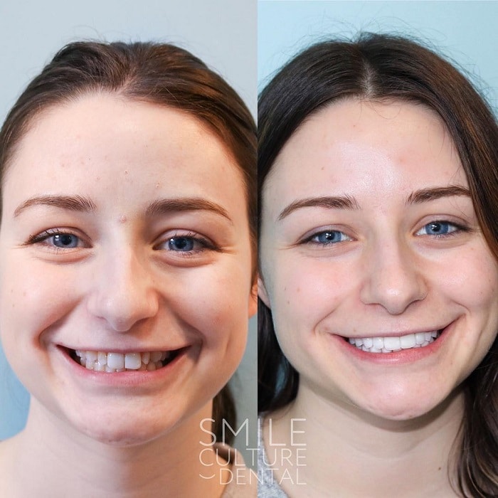 Invisalign Before and After: Transforming Your Smile with Clear Aligners