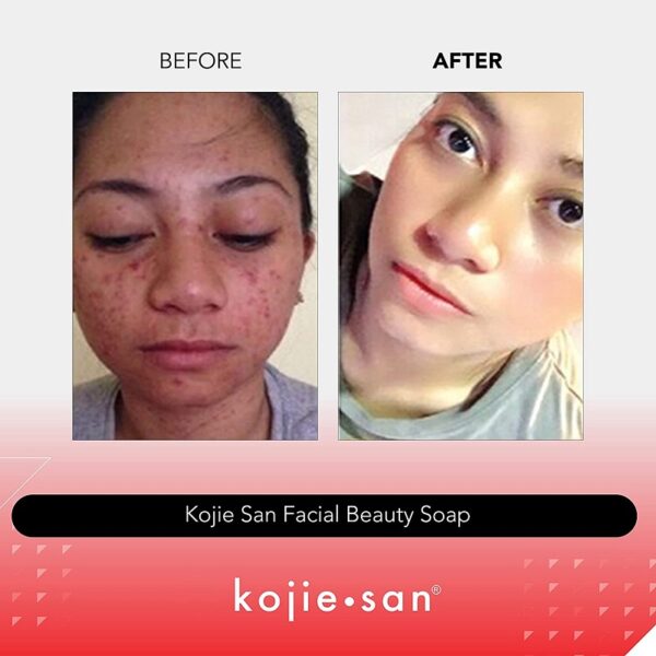 Kojic Acid Soap Before and After Does It Really Lighten Skin? Must