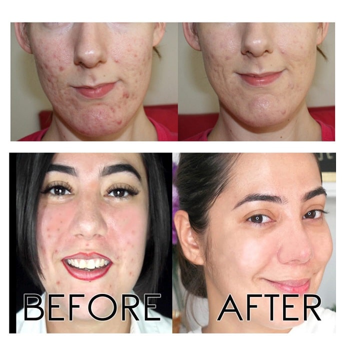The Ordinary Peeling Solution Before and After: A Comprehensive Review