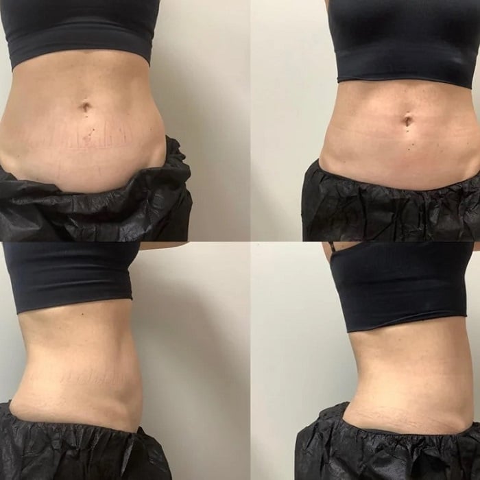 Coolsculpting Before and After: Results, Side Effects, and What to Expect 6 Coolsculpting Before and After: Results, Side Effects, and What to Expect