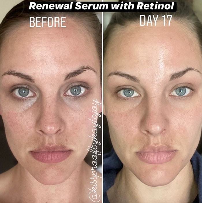 Retinol Before and After: Transform Your Skin with These Results