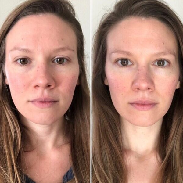 Red Light Therapy Before and After Does It Really Work? Must Read