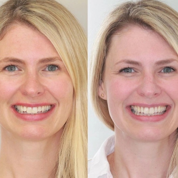 Invisalign Before and After: Transforming Your Smile with Clear Aligners