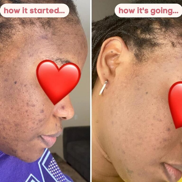 Kojic Acid Soap Before and After Does It Really Lighten Skin? Must