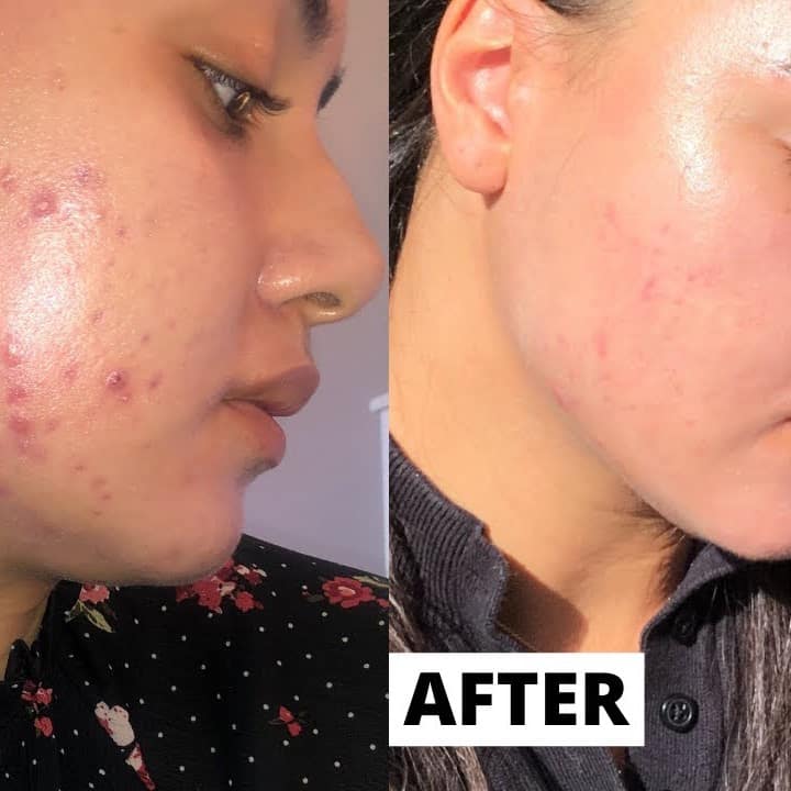 Tretinoin Before and After: A Comprehensive Analysis of its Effectiveness on Skin