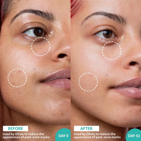 Retinol Before and After Transform Your Skin with These Results Must Read This Before Buying