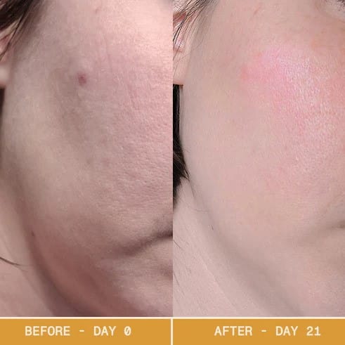 Red Light Therapy Before and After: Does It Really Work? 7 Red Light Therapy Before and After: Does It Really Work?