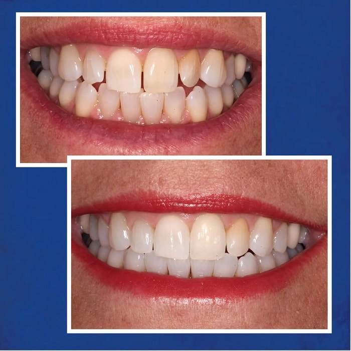 Invisalign Before and After: Transforming Your Smile with Clear Aligners