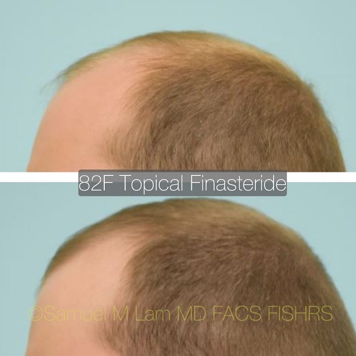 Minoxidil Before and After: Real Results and Photos