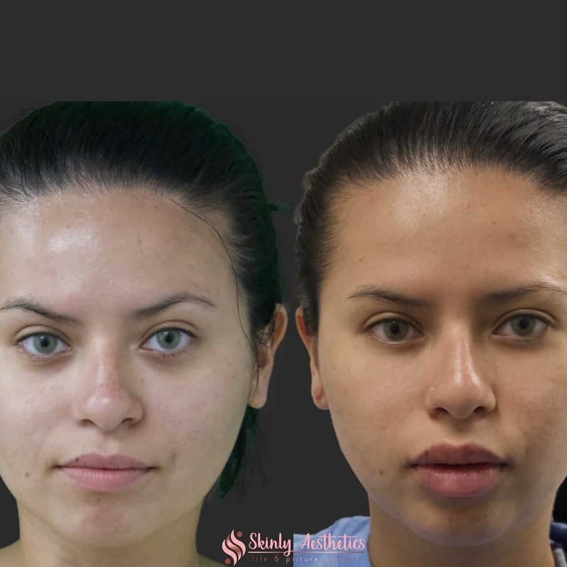 Botox Before and After: Dramatic Results and What to Expect 9 Botox Before and After: Dramatic Results and What to Expect