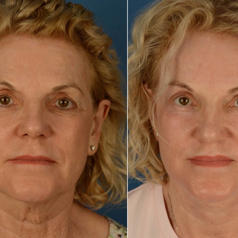 Lip Lift Before and After: Dramatic Results and Recovery Process