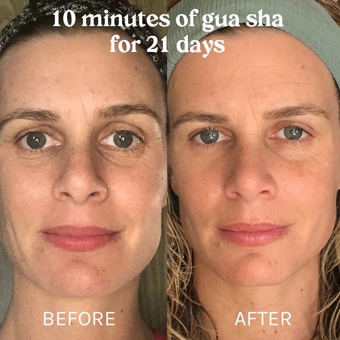 Gua Sha Before and After: Benefits and Results 9 Gua Sha Before and After: Benefits and Results