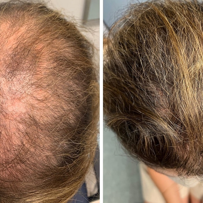 Minoxidil Before and After: Real Results and Photos