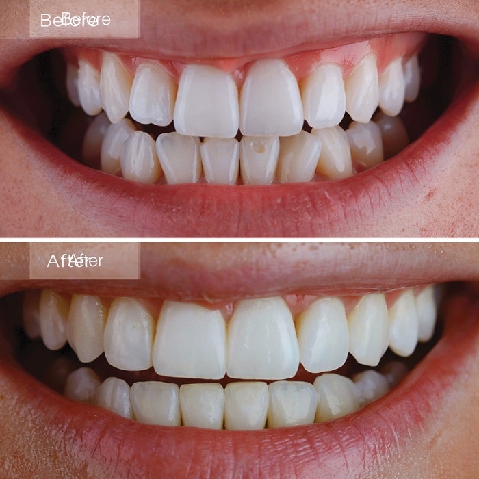 Invisalign Before and After: Transforming Your Smile with Clear Aligners