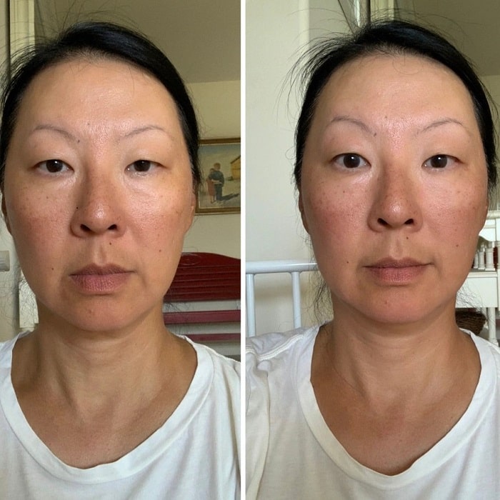Gua Sha Before and After: Benefits and Results 10 Gua Sha Before and After: Benefits and Results