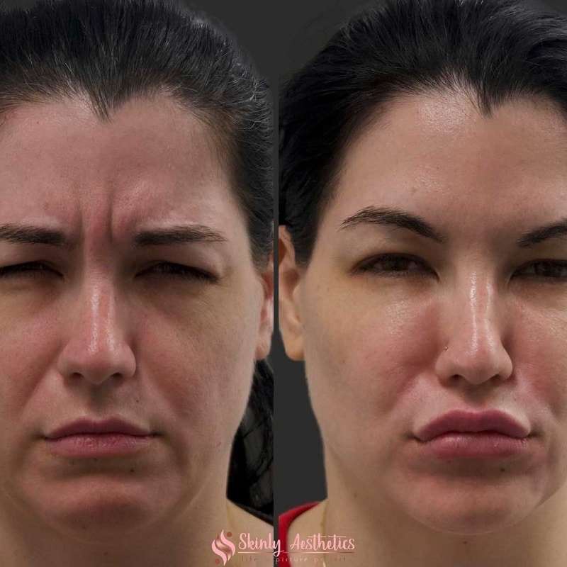 Botox Before and After: Dramatic Results and What to Expect