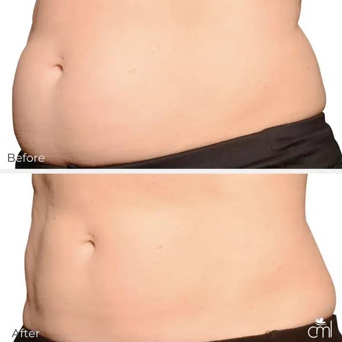 Coolsculpting Before and After: Results, Side Effects, and What to Expect 10 Coolsculpting Before and After: Results, Side Effects, and What to Expect