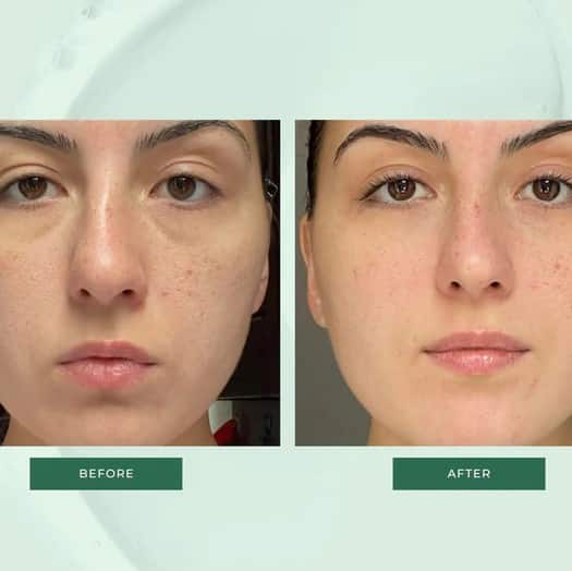 Gua Sha Before and After: Benefits and Results 5 Gua Sha Before and After: Benefits and Results