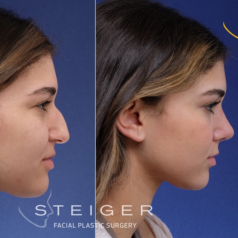 Nose Job Before and After: Dramatic Transformations and What to Expect