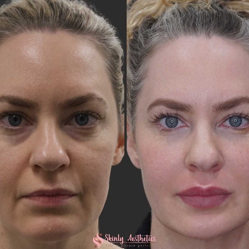 Under Eye Filler Before and After: Results and Expectations