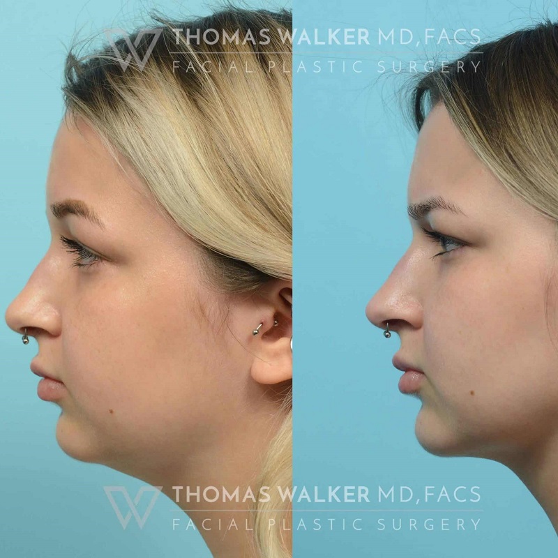 Buccal Fat Removal Before and After: What You Need to Know 2 Buccal Fat Removal Before and After: What You Need to Know