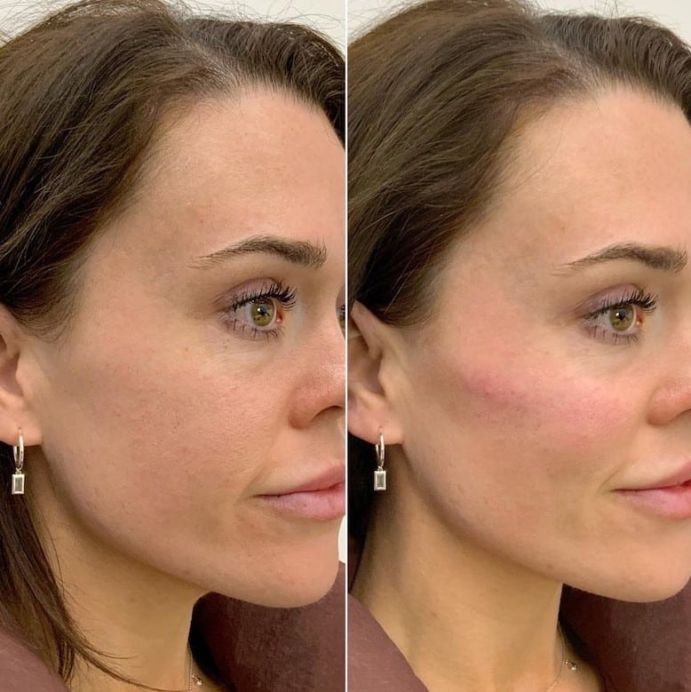 Cheek Filler Before and After: Transforming Your Appearance with Subtle Enhancements 2 Cheek Filler Before and After: Transforming Your Appearance with Subtle Enhancements