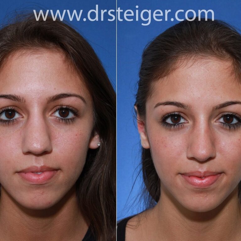 Nose Job Before and After Dramatic Transformations and What to Expect