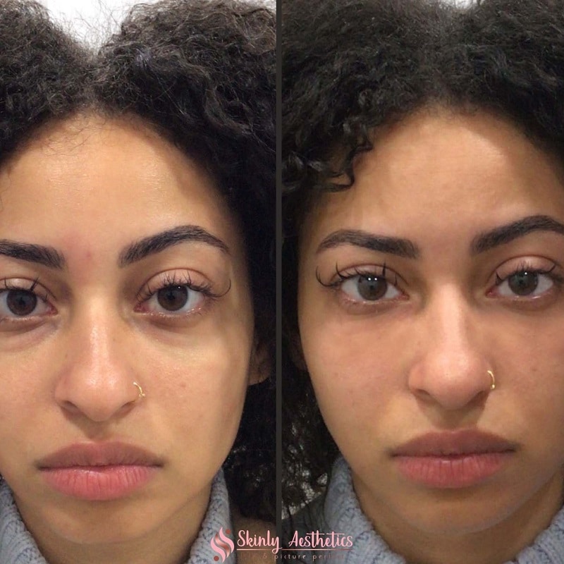 Under Eye Filler Before and After: Results and Expectations 10 Under Eye Filler Before and After: Results and Expectations