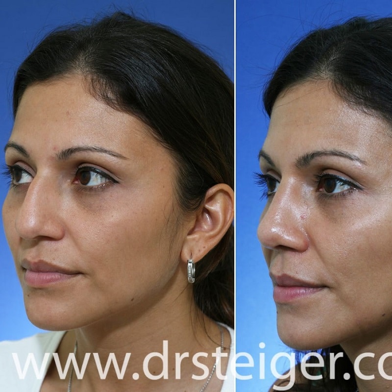 Nose Job Before and After: Dramatic Transformations and What to Expect