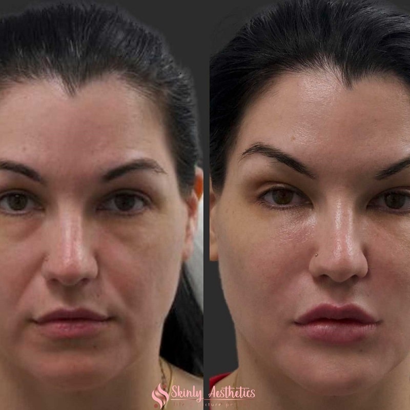 Under Eye Filler Before and After: Results and Expectations 11 Under Eye Filler Before and After: Results and Expectations