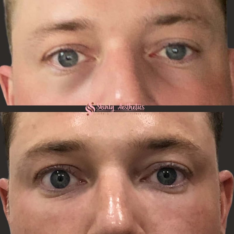 Under Eye Filler Before and After: Results and Expectations 12 Under Eye Filler Before and After: Results and Expectations